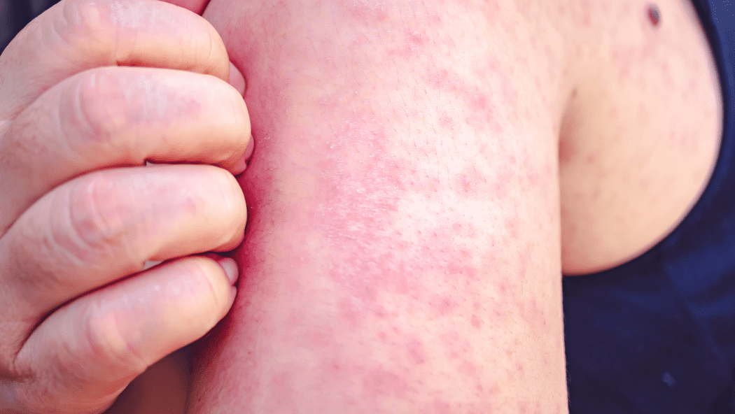 Arm of a person infected with measles, covered with a bright red rash.